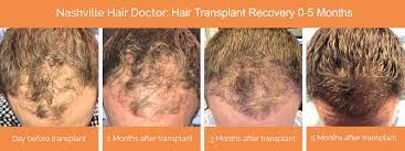 After three and four months of the surgery, the hair will start growing at least half inch per month. The Stages Of Hair Growth After Neograft Nashville Hair Doctor