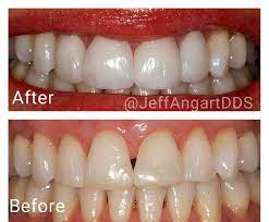 Dental Veneer Dental Veneers Teeth Straightening Dental Clinic