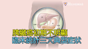 胰腺肿瘤有时候是在成像研究中被发现的——比如核磁共振（mri) 或者是计算机断层扫描（ct） ——后两者是为了探究新症状的发作或评估其它疾病而做的扫描。 胰腺肿瘤还可以在已有胰腺癌（pancreatic cancer）家族病史的家庭成员筛查中发现。 èƒ°è‡Ÿç™ŒåˆæœŸä¸æ˜Žé¡¯è‡¨åºŠçµ±è¨ˆä¸‰å¤§å…¸åž‹ç—‡ç‹€ Youtube