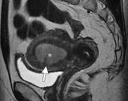 The most common symptom is pelvic pain. Figo Staging System For Endometrial Cancer Added Benefits Of Mr Imaging Radiographics