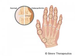 Rheumatoid Arthritis Information Sinew Therapeutics