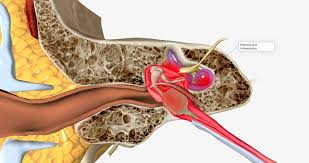 Image result for Bacterial Labyrinthitis