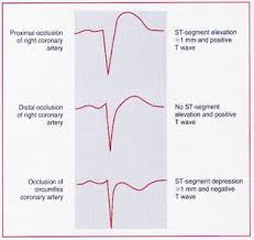 Right Ventricular Infarction Part 3 Ems 12 Lead