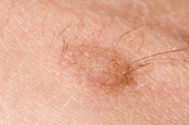 skin tags are frequently found in areas of friction on the skin, such as the neck, underarms, under the breasts, eyelids, and other skin folds. What Causes Skin Tags Acrochordon Live Science
