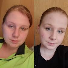 Weight loss Before and After — tinyysunflowerr: I know I'm wearing a hoodie  and...