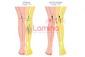 Jika diketahui sejak dini dapat dikoreksi antara lain. Bentuk Kaki X Pada Orang Dewasa Penyebab Dan Dampaknya Apa Klinik Patella