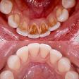 Teeth Whitening and Polishing product image