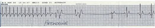 Paroxysmal svt (psvt) describes an svt with abrupt onset and offset — characteristically seen ecg features: Ecg Interpretation Of Arrhythmias Tusom Pharmwiki
