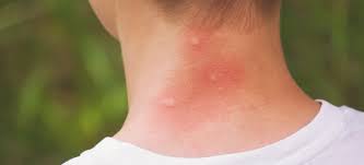 Turmeric is a magic spice that has been advocated for treating cuts, wounds and burns from time immemorial. Top 5 Home Remedies For Mosquito Bites Dr Axe