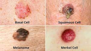 It's most common on areas often exposed to the sun, and your scalp is one of those. Types Of Skin Cancer Melanoma Basal And Squamous Cell Carcinoma Everyday Health