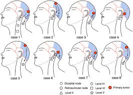 Had enlarged occipital lymph node on the right side of my neck for the past 4 to 5 week. Figure 1 Dominant Lymph Drainage Patterns In The Occipital And Parietal Regions Evaluation Of Lymph Nodes In Patients With Skin Cancer Of The Head Springerlink