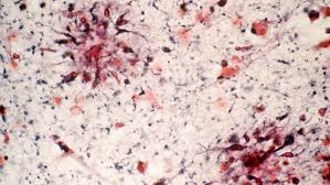 Immunotherapy (passive) (timeline) target type: The Once Scrapped Alzheimer S Drug Aducanumab May Work After All Science News
