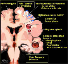3 natural ways to manage epilepsy. The Radiology Assistant Role Of Mri