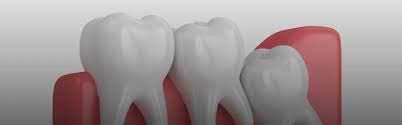 Sometimes the wisdom teeth cause pain , but a person can avoid extracting them with a few modifications of the surrounding tissues or oral hygiene habits. 5 Ways To Releave Wisdom Tooth Pain Dentistry On Coolum