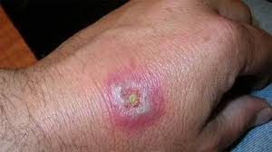 Bites And Stings Pictures Causes And Symptoms