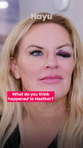 Who do you think gave Heather a black eye? #RHOSLC #HeatherGay #JenShah  #RealityTV #Hayu