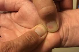 Image result for Carpal Compression Test