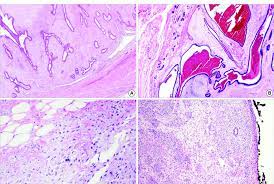 Some phyllodes tumors are between benign and cancerous. A Well Circumscribed Pushing Border Of A Benign Phyllodes Tumor A And Download Scientific Diagram