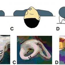 Repeat this daily until free from positional vertigo for 24 hours. The Reverse Epley Manoeuvre For The Treatment Of Left Asc Download Scientific Diagram