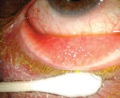 Image result for lesion sclera