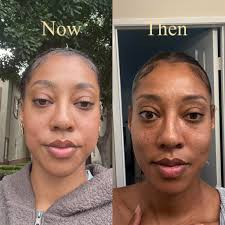 I love seeing how far I've come 💛 My thyroid hormones—including TSH—have  been in a great range since early 2024, but getting my eyes to calm down  naturally (without surgery!) took a