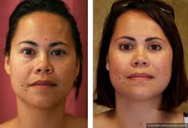 The result is smoother skin and a refreshed new look. Patient 9888 Asian Eyelid Surgery Blepharoplasty Before And After Photos Beverly Hills Plastic Surgery Gallery Los Angeles Ca Dr Sean Younai