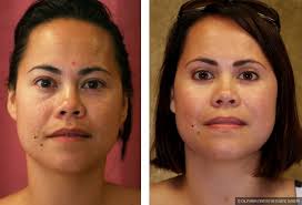 Christopher chang is one of the most qualified surgeons for your cosmetic needs. Patient 9888 Asian Eyelid Surgery Blepharoplasty Before And After Photos Beverly Hills Plastic Surgery Gallery Los Angeles Ca Dr Sean Younai