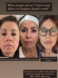 Although we are not done with the Sculptra treatments, I am so happy with  the results. If you were even considering this procedure, you should check  her out. My injector is the