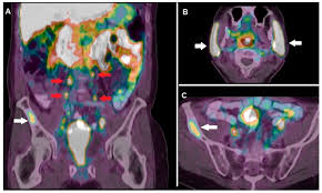Cumpara acum, 100% sigur prin garantia de livrare. Ijms Free Full Text Prognostic And Theranostic Applications Of Positron Emission Tomography For A Personalized Approach To Metastatic Castration Resistant Prostate Cancer Html