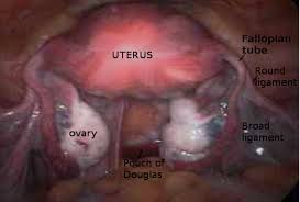 Laparoscopy, with its advantages and limitations, requires a different topographic comprehension of surgical anatomy, adapted to a certain angle of vision and magnification. Figure Pelvis Laparoscopy Image Courtesy O Chaigasame Statpearls Ncbi Bookshelf