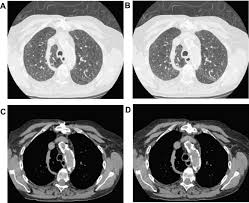 A ct was performed on a healthy subject, with an axial enhanced acquisition with different windows: Low Dose Chest Ct Protocol 50 Mas As A Routine Protocol For Comprehensive Assessment Of Intrathoracic Abnormality Sciencedirect