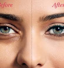 Unlike most microbial killers that invade and infect our bodies, clostridium botulinum does not cause disease as most pathogenic bacteria do (ingraham, p.233). Pain Free Botox And Under Eye Dermal Fillers Wembley Clinic