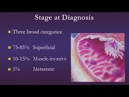 Image result for Bladder Cancer