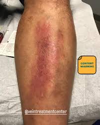 Image result for Stasis Dermatitis