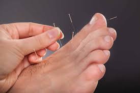 Dry Needling Therapy - The Foot and Ankle Clinic