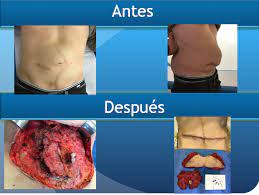Casos Reales Antes Y Despues Clinica Hernia