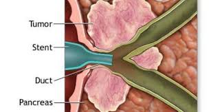 Pin On Pbc Other Liver Disease