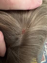 Image result for sores on the head in children