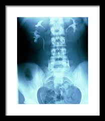 Image result for Intravenous Pyelogram