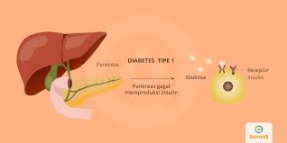 Perbedaan dm tipe 1 dan 2 selanjutnya adalah dari sisi gejala. Diabetes Tipe 1 Tanda Dan Gejala Penyebab Cara Mengobati Cara Mencegah