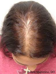 This article attempts to discuss several causes of hair thinning in women, preventive measures, and the recommended treatments available. Female Pattern Hair Loss American Osteopathic College Of Dermatology Aocd