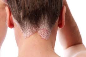 ساعي الي الخير ما هو مرض الصدفية psoriasis مرض facebook