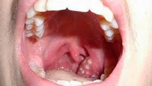Angina Foto Simptomy I Shema Lecheniya Chem Lechit Anginu