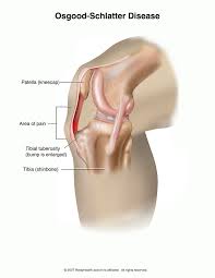 Osgood Schlatter Disease Singapore Sports Clinic