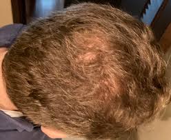 Preparing for microneedling at home download article. Back On Propecia After Massive Shed Of Topical Finasteride Hair Loss Drugs Hair Restoration Network Community For And By Hair Loss Patients