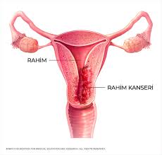 Check spelling or type a new query. Rahim Kanseri Nedir Neden Olur Belirtileri Nelerdir