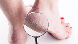 Risih karena kulit tangan mengelupas? 5 Hal Yang Bisa Sebabkan Kulit Kaki Kering Dan Pecah Pecah