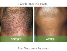 Laser hair removal can be done safely in people of color. Laser Hair Removal Cade Clinique