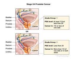 prostate cancer is the third leading cause of cancer death in american men, behind colorectal &amp; Prostate Cancer Treatment Pdq Treatment Patient Information Nci Cs Mott Children S Hospital Michigan Medicine