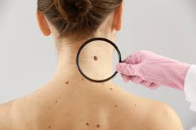 Up to 40% of tumors are a mix of two or more subtypes. Understanding Different Skin Cancer Types Treatments Apotheco Pharmacy